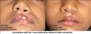 Before After Pictures,Cosmetic surgery,Delhi, incomplete cleft lip nose